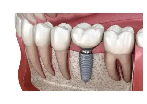 Implant Restorations for Long-Lasting Missing Tooth Solutions