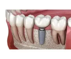 Implant Restorations for Long-Lasting Missing Tooth Solutions