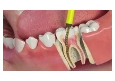 Infected Tooth Treatment for Sudden Severe Toothache