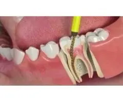 Infected Tooth Treatment for Sudden Severe Toothache