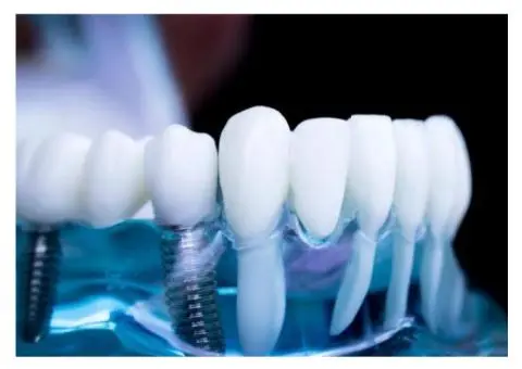 Dental Implants Willoughby