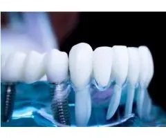 Dental Implants Willoughby