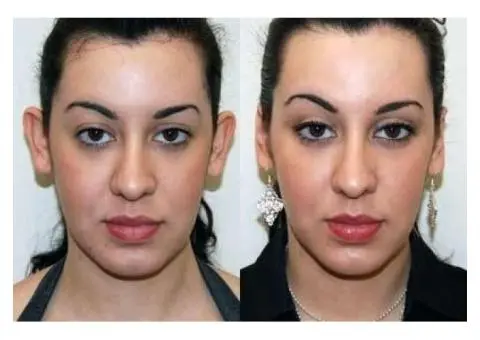 Non Surgical Otoplasty Sydney: Instant Ear Pinning Fix