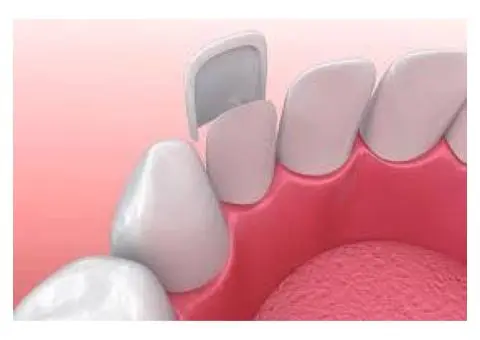 Veneers canberra cost