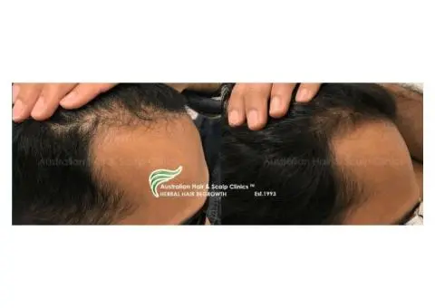 Targeted Care for Male Facing Pattern Baldness