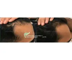 Targeted Care for Male Facing Pattern Baldness