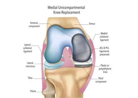 Ease Your Knee Pain with Partial Knee Replacement Surgery 