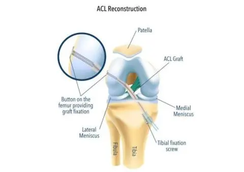 Restore Knee Strength with Precise ACL Ligament Reconstruction 
