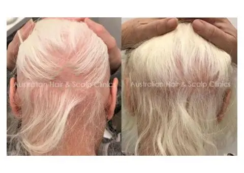 Natural Support for Alopecia Areata Recovery