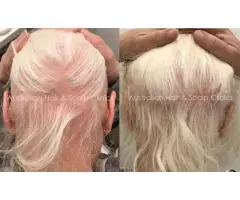 Natural Support for Alopecia Areata Recovery