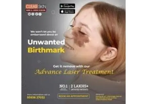 portwine stain treatment in india