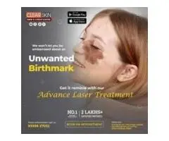 portwine stain treatment in india