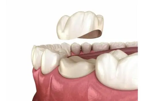 Simply Restore Your Smile Through Reliable Tooth Crown Services Campbelltown!