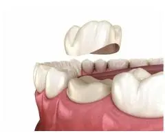 Simply Restore Your Smile Through Reliable Tooth Crown Services Campbelltown!