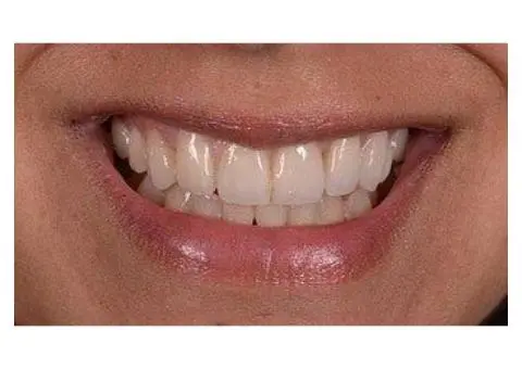 Crowns Teeth to Restore Your Confidence?