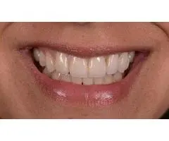 Crowns Teeth to Restore Your Confidence?