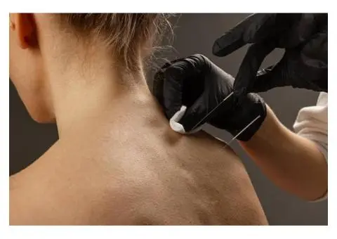 Trigger Point Dry Needling Perth – Fast Pain Relief - 3/4