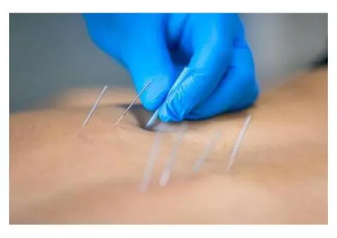 Trigger Point Dry Needling Perth – Fast Pain Relief - 4/4