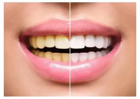 Tooth Bleaching: Dentist-Supervised Care for Sensitive Teeth