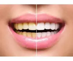 Tooth Bleaching: Dentist-Supervised Care for Sensitive Teeth