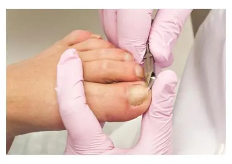 Get the Best Ingrown Toenail Treatment in Black Rock