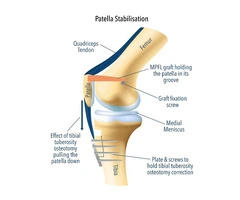 Patella Fracture Support for Safer Recovery