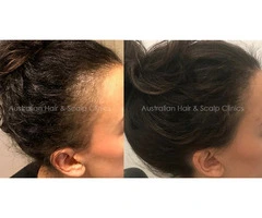 Female Hair Loss Support with Personal Care Focus