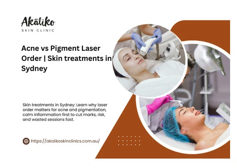 Laser for Acne vs Pigmentation in Sydney: Why the Order Matters