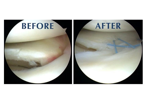 Torn Meniscus Treatment That Supports Active Living