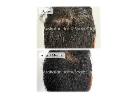 Hair Follicle Regeneration-Based Restoration Care