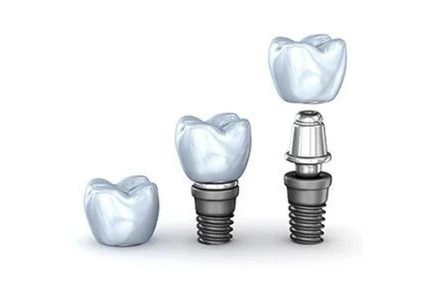 Trusted Dental Implant Specialist in Dandenong