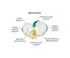Knee Meniscal Tear Support That Helps You Move