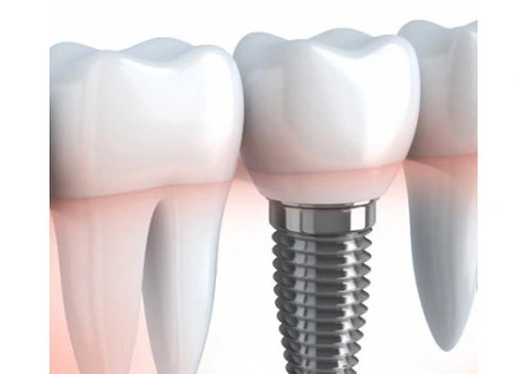 Best Dental Implants Melbourne by Experienced Dentists