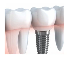 Best Dental Implants Melbourne by Experienced Dentists