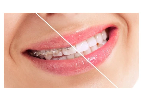 Braces Zetland - 2/3