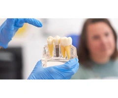 Dental Implant Specialists in Port Macquarie