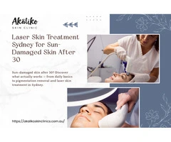 A Guide to Pigmentation Removal in Sydney After 30