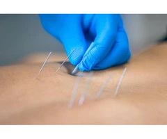 Trigger Point Dry Needling in Perth – Pain Relief