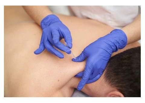 Trigger Point Dry Needling in Perth – Pain Relief - 2/2