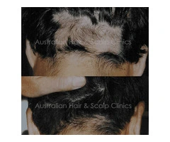 Hair Loss Treatment Designed for Long-Term Scalp Care