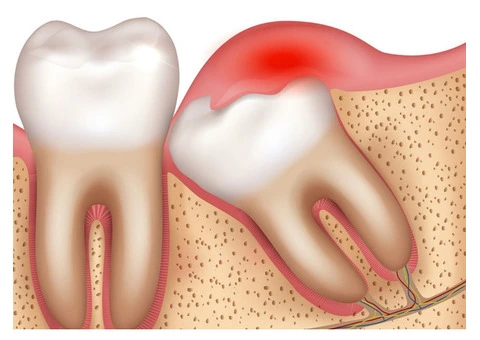 Why Getting Wisdom Tooth Extraction By Expert Dentist Is Must?