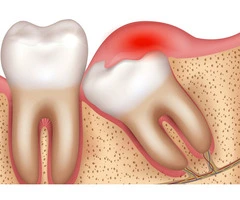 Why Getting Wisdom Tooth Extraction By Expert Dentist Is Must?