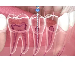 Affordable Cost Root Canal in Campbelltown for Your Needs