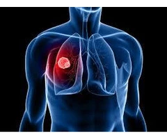 Lung Cancer Donnybrook