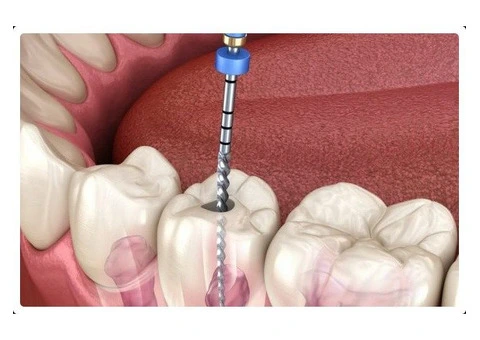 Best Dental Care for Root Canal Treatment Melbourne CBD