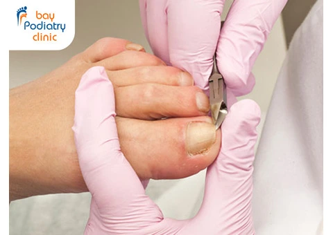 Get the Best Ingrown Toenail Treatment in Highett