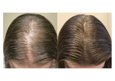 Natural Hair Regrowth Methods to Regrow Hair Naturally