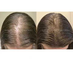 Natural Hair Regrowth Methods to Regrow Hair Naturally