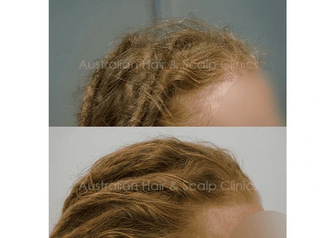 Hair Regrowth Treatment Sydney with Personalised Care
