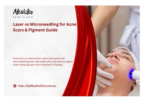 Laser vs Microneedling for Acne Scars & Pigment Guide